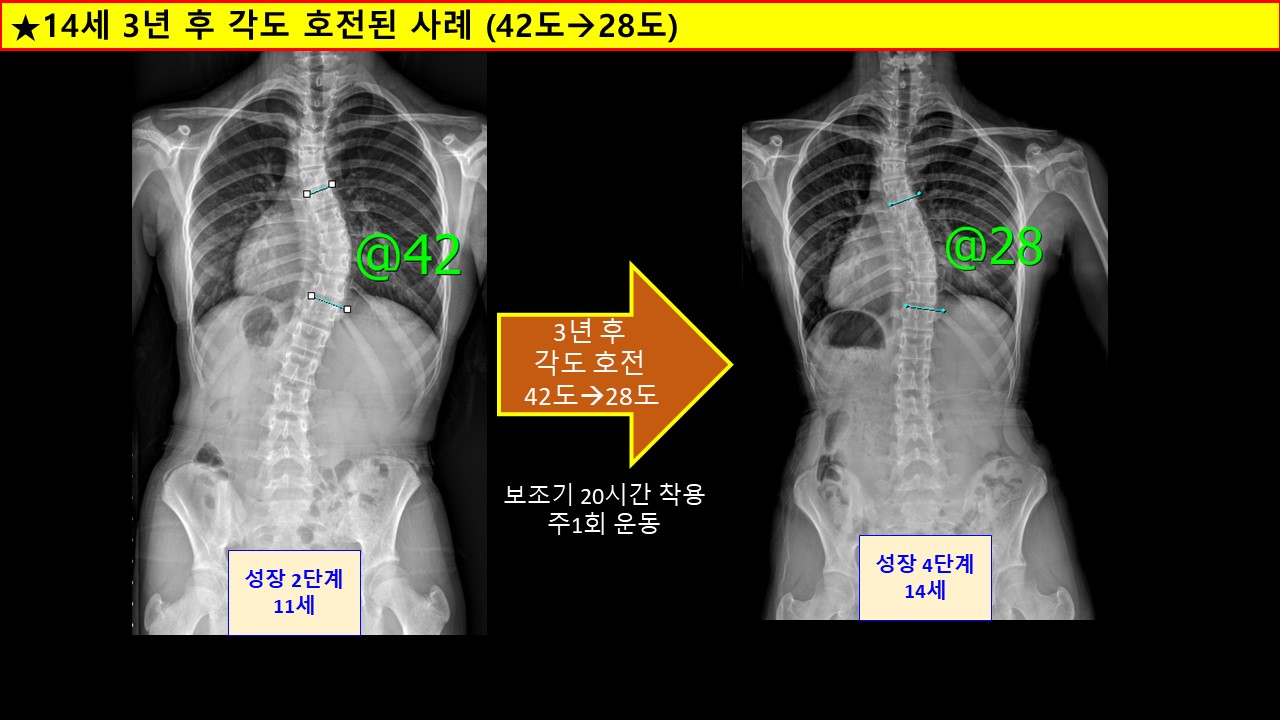 14세각도호전.jpg